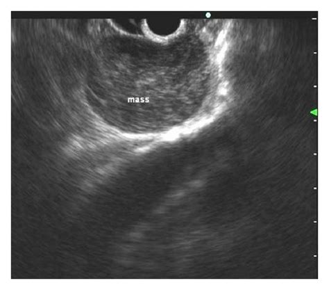 Endoscopic Ultrasonography Showing A Hypoechoic Mass With A Slightly Download Scientific