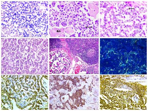 Microscopic Findings A Cellular Smears From Left Lobe Showing Tumor Download Scientific