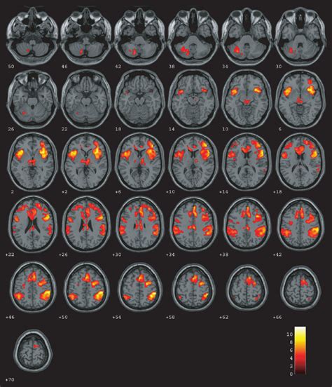 Statistical Parametric Maps Of The Enhanced Neural Activity During The