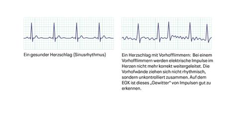 Vorhofflimmern Ursachen Symptome Behandlung