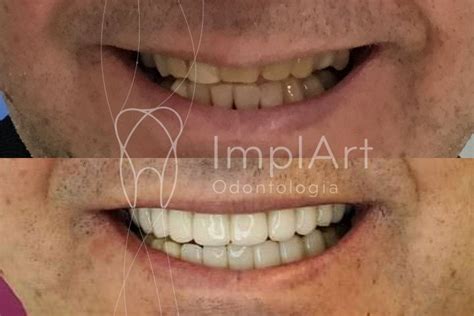 Reabilitacao Protese Metaloceramica Antes E Depois Kb Implart