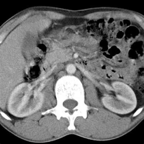 Tomodensitom Trie Coupe Axiale Abdominale Montrant Une Masse