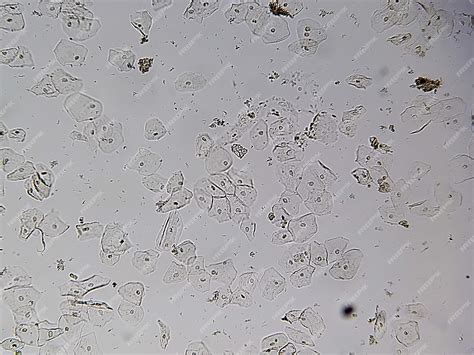 Epithelial Cells In Urine Microscopy