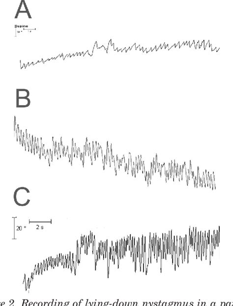 Figure From Nystagmus While Recumbent In Horizontal Canal Benign