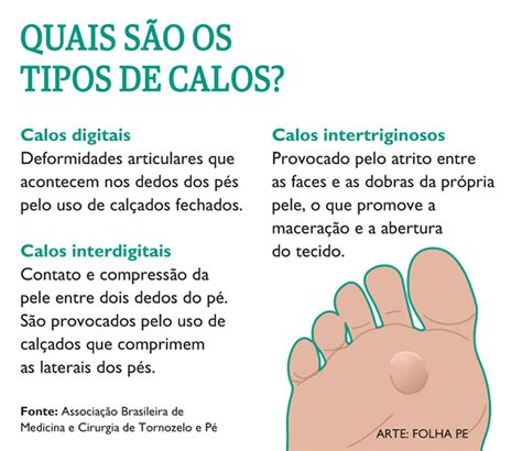 O Que Causa Calo Nos Pés - Por que os calos incomodam tanto? Ortopedista explica como cuidar da ...