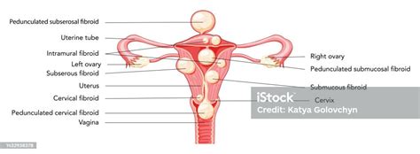 Uterine Fibroids Female Leiomyomas Reproductive System Uterus Diagram