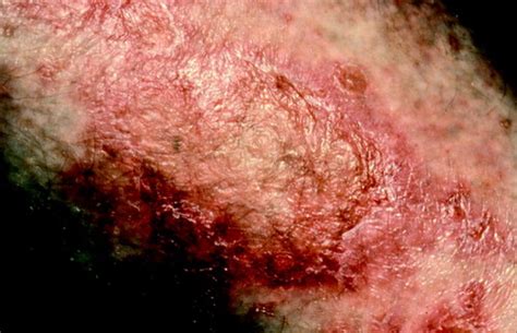 Cutaneous Manifestations Of Internal Malignancy Thiers 2009 Ca A Cancer Journal For