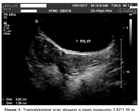 Figure 1 From Hysteroscopic Resection Of A Giant Cervical Polyp With