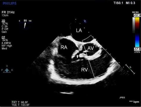 LA Left Atrium AV Aortic Valve RV Right Ventricle RA Right