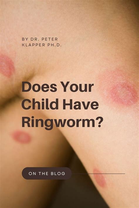 How To Identify And Treat Ringworm With Pictures Artofit