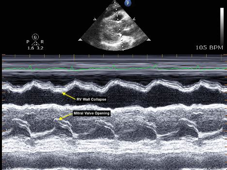 Em Ultrasound Section Cardiac Tamponade And Ultrasound Guided | Hot Sex Picture