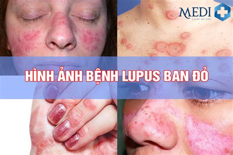 Lupus Ban Do Sale Online Emergencydentistry