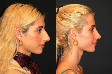 Nostril Reduction Facelift Procedure Hair Growth Charts Rhinoplasty