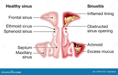 Healthy Sinus And Sinusitis Medical Illustration Labeled Stock