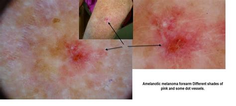 Dermoscopy Made Simple Amelanotic Melanoma