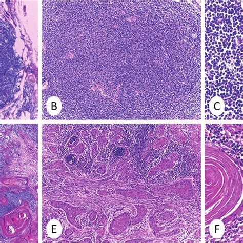 Pdf Synchronous Metastatic Cutaneous Squamous Cell Carcinoma And