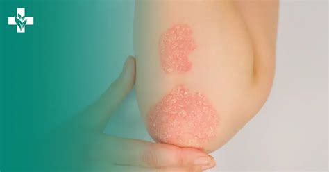 What Are The Early Warning Signs Of Psoriatic Arthritis