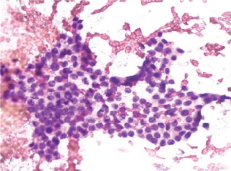 The Morphological Features Of Fine Needle Aspiration Cells In Ptc