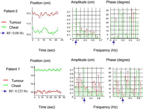 Esophageal Cancer Determination Of Internal Target Volume For