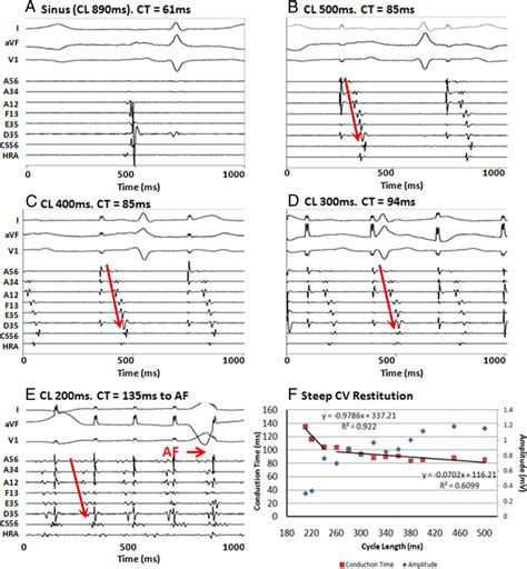 Figure From Atrial Conduction Slows Immediately Before The Onset Of