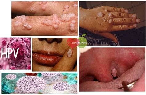 Mancha Na Pele Hpv - HPV (papilomavírus humano) - Causas, Sintomas e Tratamentos | Dicas de ...