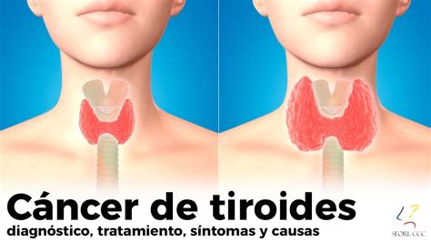 CÁNCER DE TIROIDES diagnóstico tratamiento síntomas causas YouTube