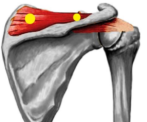 Supraspinatus Triggerpoint Online Emergencydentistry