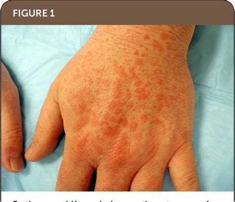 Figure 1 From Erythema Multiforme Recognition And Management Semantic Scholar