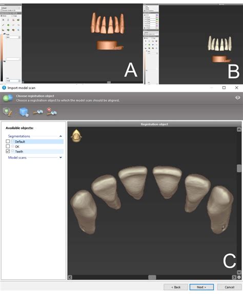 Dynamic Navigation In Endodontics Guided Access Cavity Preparation By Means Of A Miniaturized