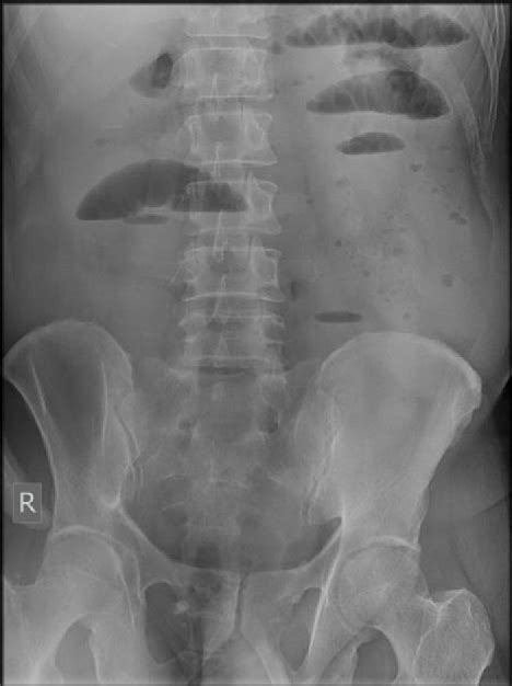 Ileo Caecal Intussusception Secondary To Lipoma In An Adult A Rare Cause For Intestinal