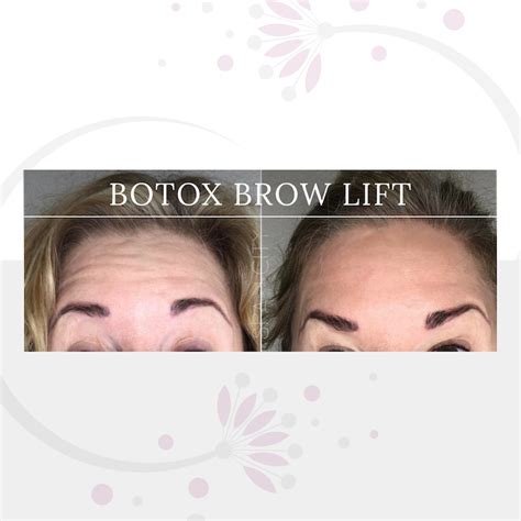 Botox Brow Lift In Dallas Lifted Brows Without Surgery