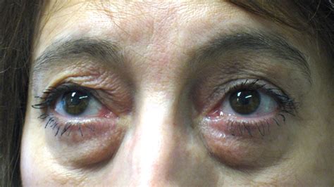 Lower Blepharoplasty Gone Wrong