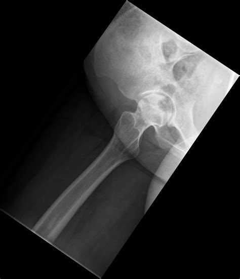 Bilateral Hip Avascular Necrosis Image