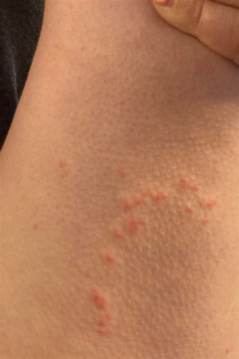 I Have A Rash On The Inside Of My Thigh Please Help Me Identify The Cause Dermatologyquestions