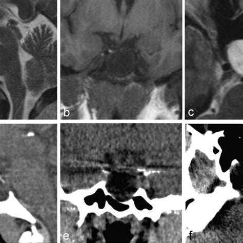 Non-contrast MRI (panels a–c) of the pituitary gland with sagittal (a)... | Download Scientific ...