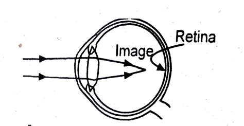 Observe The Defect Of Vision In The Diagram What Is The Defect Of Vision