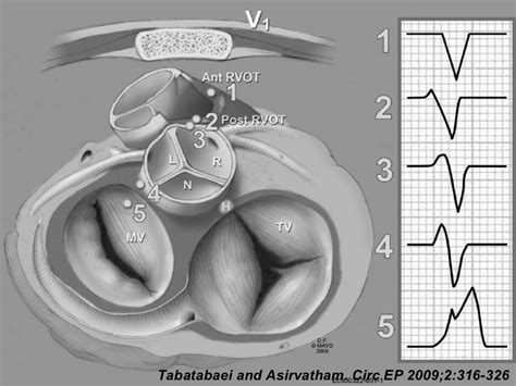 Catheter Ablation Of Ventricular Tachycardia