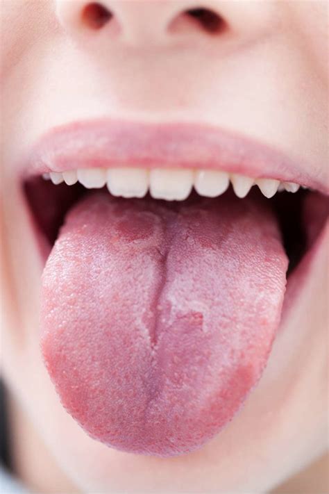 Psoriasis On Tongue