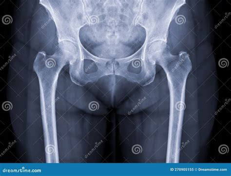 X-ray Image of Both Hip Joint Stock Image - Image of anatomical, bone ...