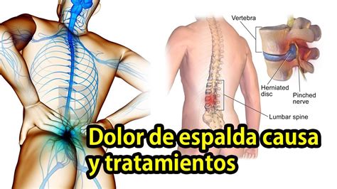 Dolor De Espalda Causa Y Tratamientos Youtube