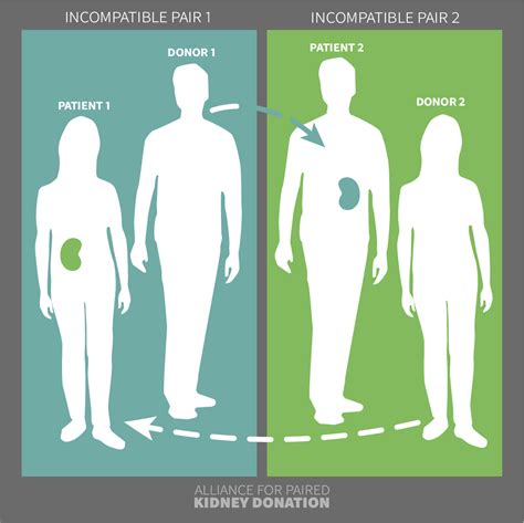 The Lifesaving Process Of Paired Kidney Donation Alliance For Paired