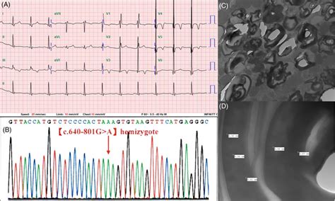 The Lead Electrocardiography Showed Sinus Rhythm With Right Bundle