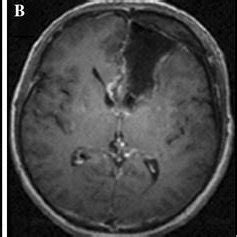 Histology of glioblastoma multiforme and gliosarcoma are shown. a ...