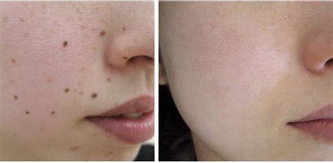 Mole Removal Before And After | Everything You Need To Know