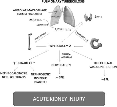 Resolution Of Hypercalcemia And Acute Kidney Injury After Treatment For