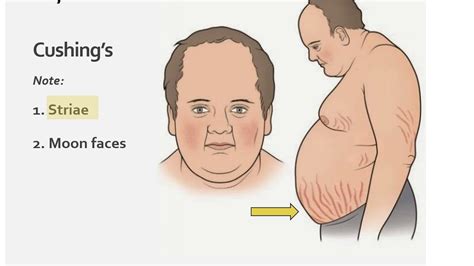 Cushings Disease Or Syndrome And Obstructive Sleep Apnea Osa Youtube