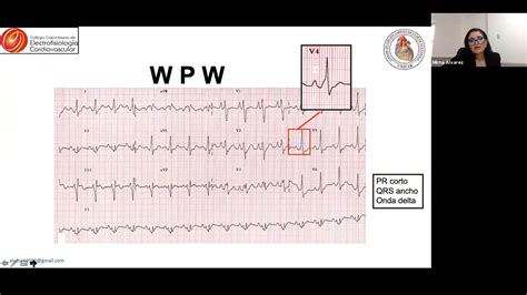 Sindrome De Wolff Parkinson White Asintomatico Evaluacion De Riesgo Y