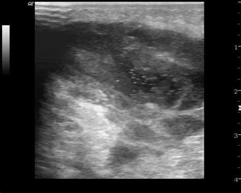 Axillary Abscess Image