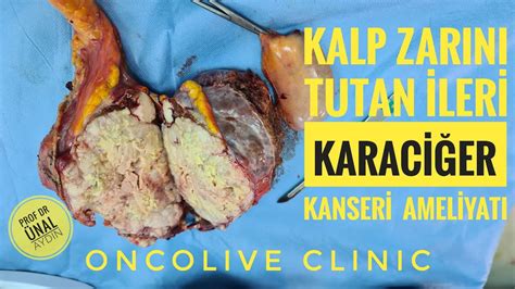 KALP ZARINI TUTAN İLERİ KARACİĞER KANSERİ AMELİYATI PROF DR ÜNAL