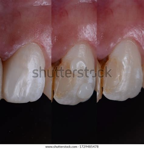 4 Tooth Coloured Fillings Before After Images, Stock Photos, 3D objects ...